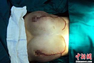 切除乳房图片